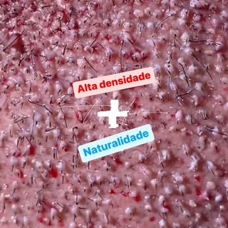 Calvície extensa, resolvida com a implantação de 4100 folículos, com espessura mais calibrosa que o 