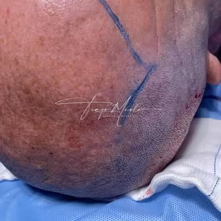 Caso de hoje resolvido com sucesso. Nossa missão é te proporcionar resultados NATURAIS. #transplante