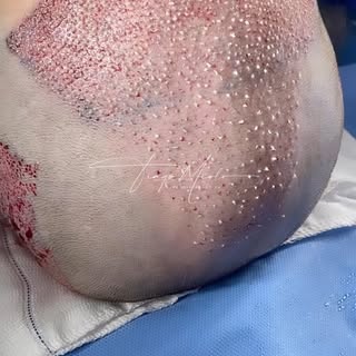 Se você é jovem, está perdendo cabelos, nunca fez um tratamento clínico antes com loções, medicament