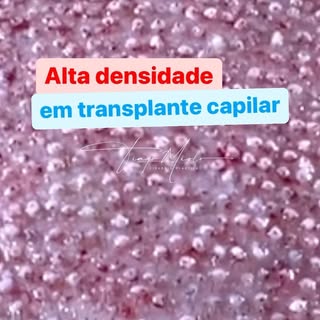 Desde que as condições do paciente permitam, nosso foco SEMPRE é DENSIDADE com NATURALIDADE  #transp