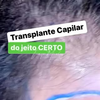 #transplantecapilarfue para melhora da região frontal. Nosso amigo queria mais volume no topete. Con