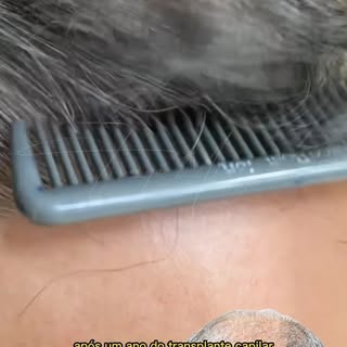 11 meses de evolução do #transplantecapilaraltadensidade . Nosso amigo teve um belo rejuvenescimento