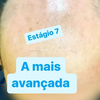 Correção de calvície estágio 7, a mais avançada dentre as calvície. Lembre-se: transplante capilar B