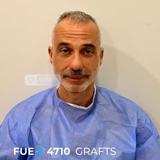 Our patient from Barcelona 🇪🇸

4,710 grafts were carefully transplanted using our customized Sapph