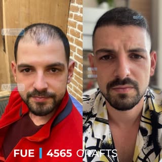 10-month result • Our patient from Belgium 🇧🇪

A soft, natural hairline, balanced density, and a r