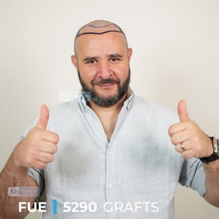 Our patient from London 🇬🇧

5,290 grafts were carefully transplanted as part of a personalized tre
