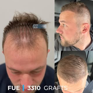 Our patient from the Netherlands 🇳🇱

A look at his progress just 5 months after a 3,310 graft hair