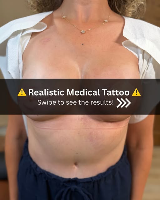 Areola tattoo on a surgically reconstructed nipple + scar camouflage tattooing on DIEP flap scars.

