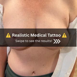 A reconstructed nipple can create physical projection and shape, but a 3D areola tattoo can add the 