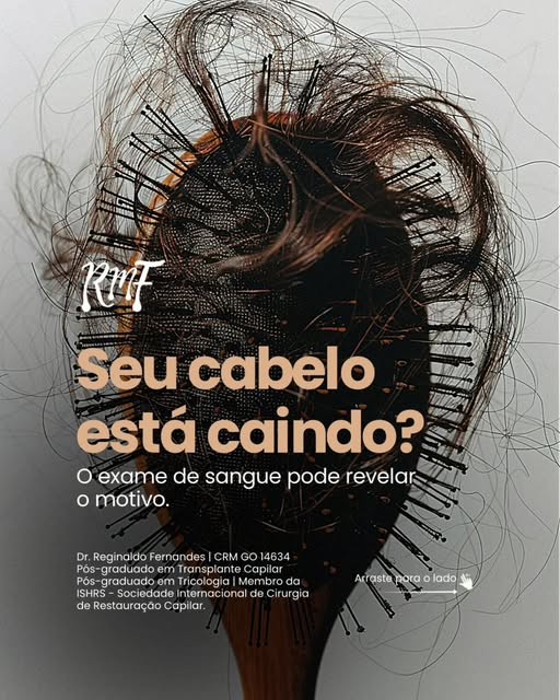 A queda de cabelo pode estar relacionada a alterações nutricionais e metabólicas. Por isso, em algun