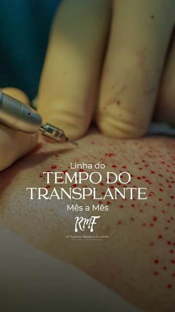 O resultado do transplante capilar não aparece de um dia para o outro. A evolução acontece gradualme