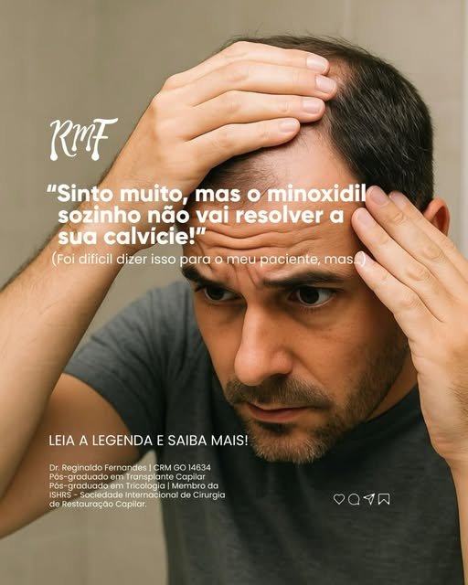 Foi difícil dizer isso para o meu paciente, mas tratar calvície exige honestidade.

O minoxidil pode