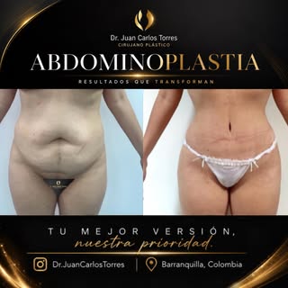 ✨ 𝐀𝐁𝐃𝐎𝐌𝐈𝐍𝐎𝐏𝐋𝐀𝐒𝐓𝐈𝐀 | 𝐑𝐄𝐒𝐓𝐀𝐔𝐑𝐀𝐂𝐈𝐎𝐍 𝐃𝐄 𝐋𝐀 𝐏𝐀𝐑𝐄𝐃 𝐀𝐁𝐃𝐎𝐌𝐈𝐍𝐀𝐋
