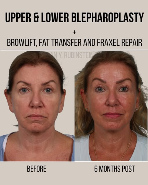 6 months post-op from a full-facial rejuvenation incorporating a brow lift, upper and lower blepharo
