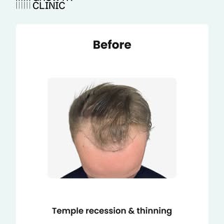 The power of a hair transplant! ✨
1,600 grafts. 12 months. A restored hairline.
Ready to start your 