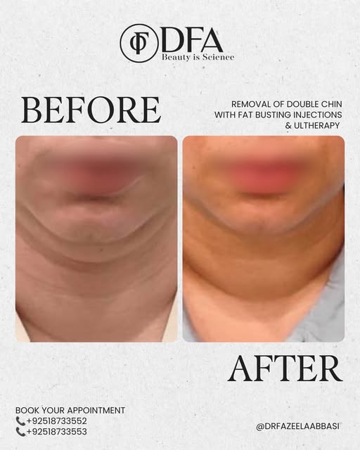 The smart way of removing a double chin is with fat busting injections and Ultherapy. This transform