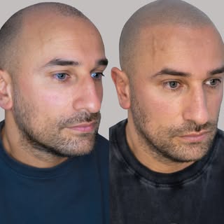 AMAZING HAIR PIGMENTATION BEFORES & AFTERS by @smp_by_nigel 🤩

🚨 NIEUW IN ZWOLLE & ENSCHEDE ! 🚨


