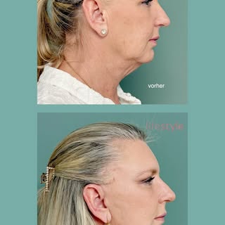 Ein Facelifting, das Natürlichkeit bewahrt und Konturen neu definiert – die TV-Sendung «Lifestyle» v