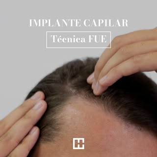 Qué es la técnica 𝙁𝙐𝙀 ?

Significa 𝙀xtracción de 𝙐nidad 𝙁olicular, mejor conocida como técnica