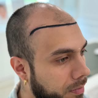 🔹 Reconstrucción capilar masculina en acción 🔹
Aquí mostramos el antes, el diseño y el resultado i