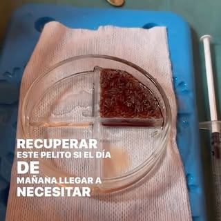 Muchos pacientes me preguntan:
“¿Y si me quedo sin pelo atrás después del trasplante?”

La respuesta