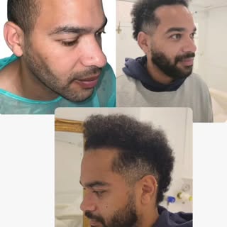 ✨ Transformación real.
De la calvicie a un resultado natural y armónico.

👨‍⚕️ Trasplante capilar r