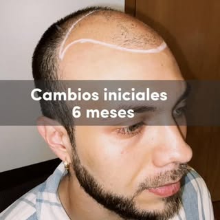 #drarielcotignola #implantecapilarbarcelona