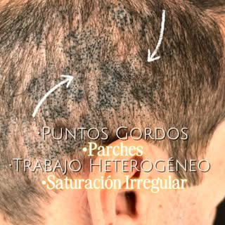 Micropigmentación capilar reparadora.

Otro caso de MPC mal hecho, un trabajo de camuflaje de cicatr
