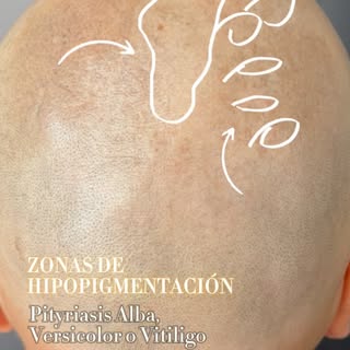 ✨ Micropigmentación capilar en piel con manchas ✨

¿Sabías que no todas las pieles reaccionan igual 