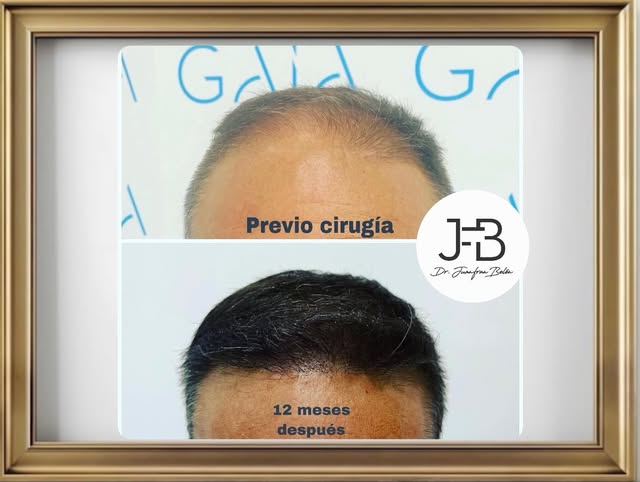 — 12 MESES POST CIRUGÍA CAPILAR!! —
Ahora toca mantenimiento con tratamiento Médico (Vía Oral o Meso