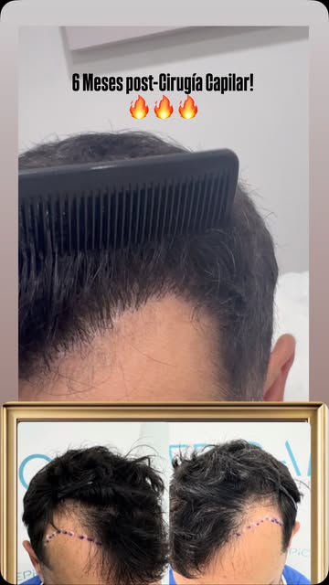 #trasplantecapilar #cirugiacapilar #fue #zafiro #resultadosreales