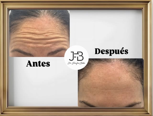 — NEUROMODULADORES, LOS QUE NUNCA FALLAN! —
Has probado el efecto del Bot*x alguna vez??… o te han h