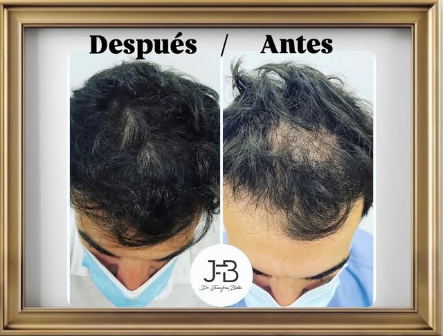 — TRATAMIENTO CAPILAR SIN CIRUGÍA (PACK HAIR RESTORATION!! —

Estás tardando a dar el@paso a tu Rest