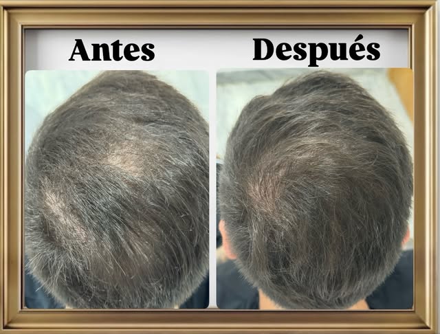 — UN PACK DE HAIR RESTORATION QUE COMIENZA A DAR LA CARA —
Como lo ven?… va progresando?…😏
Te expli