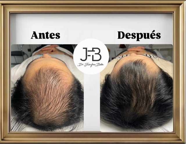 — NUEVO CASO DE RESULTADOS DE NUESTRO PACK HAIR RESTORATION SIN CIRUGÍA! —
Paciente de nuestra Epica