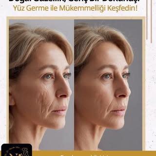 Doğal Güzellik, Genç Bir Dokunuş: Yüz Germe ile Mükemmelliği Keşfedin!

Yüz Germe (Facelift) Nedir?
