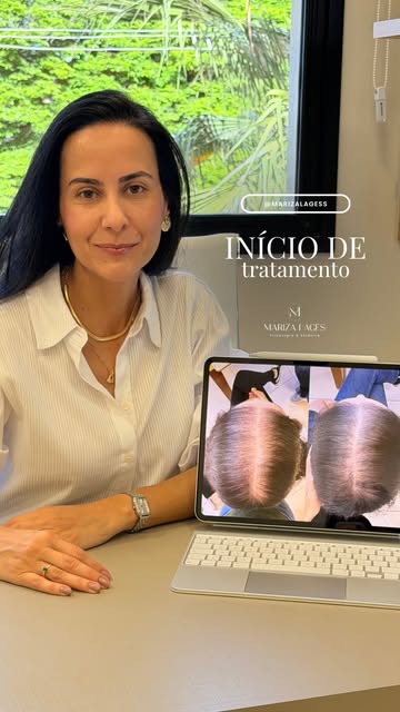 Resultado de uma paciente de apenas 24 anos, em tratamento para alopecia androgenética.

Com apenas 