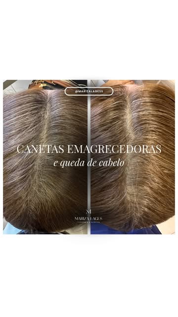 Canetas emagrecedoras podem estar associadas à queda de cabelo — mas, muitas vezes, o problema não é