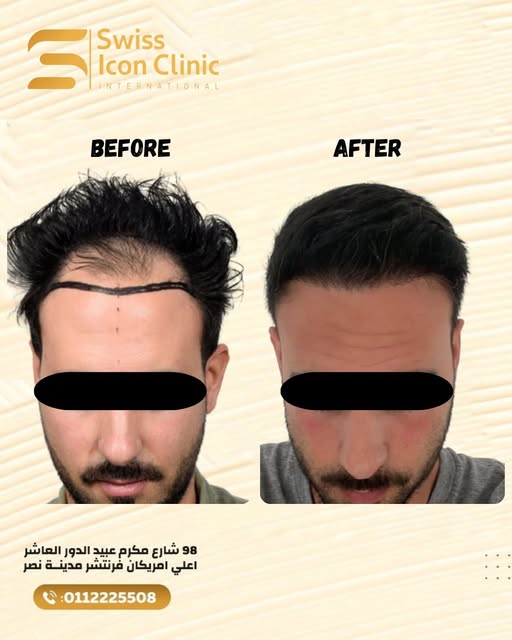 نتيجة رائعة لزراعة ٣٠٠٠ جرافت 👌
لو عايز تعرف أكتر، إحنا هنا للمساعدة!
📞للحجز موبايل أو واتساب: 011