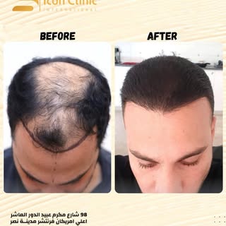 نتيجة رائعة لزراعة ٣٥٠٠ جرافت 👌
لو عايز تعرف أكتر، إحنا هنا للمساعدة!
📞للحجز موبايل أو واتساب: 011