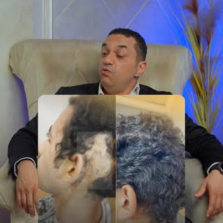 الصلع مش نهاية الحكاية… دي ممكن تكون بداية جديدة!
في الفيديو ده هنكشفلك أسرار مهمة قبل ما تاخد قرارك