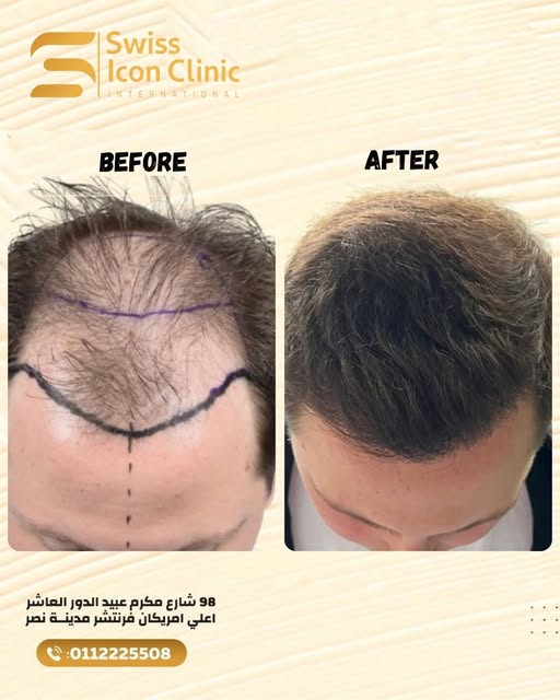 نتيجة رائعة لزراعة ٣١٠٠ جرافت 👌
لو عايز تعرف أكتر، إحنا هنا للمساعدة!
📞للحجز موبايل أو واتساب: 011