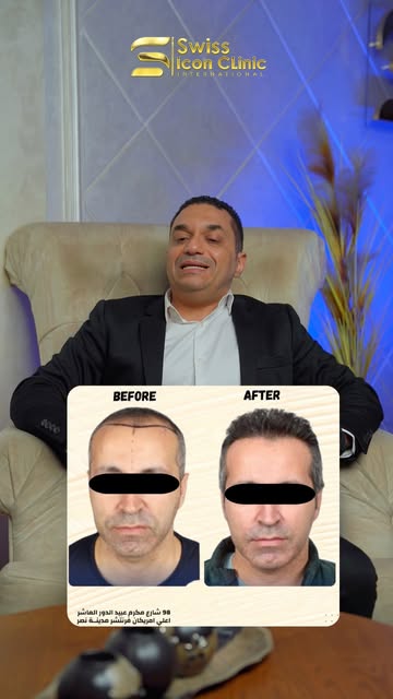 متخليش السعر يخدعك قبل متختار المكان اللي هتعمل فية زراعة شعر لازم تتفرج علي الفيديو دة 🧐
📞للحجز م