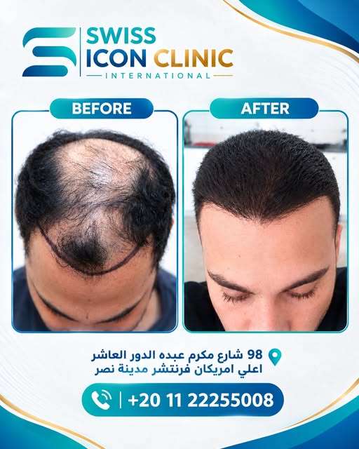 نتيجة رائعة لزراعة ٣٥٠٠ جرافت 👌
لو عايز تعرف أكتر، إحنا هنا للمساعدة!
📞للحجز موبايل أو واتساب: 011