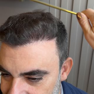 O efeito de 4.700 folículos 🌱 numa calvície grau 5.

Gostou? 

Eu amei! 🤩

Dra Nathalia Ávila
Médi