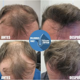 Resultado 6 meses post op #fue #fuss #tira #mujer #pelo #trasplantecapilar #hairrestoration #villodr