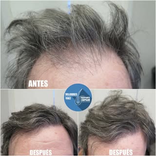 Línea anterior masculina. Resultado muy natural #fue #fuss #tira #mujer #pelo #trasplantecapilar #ha