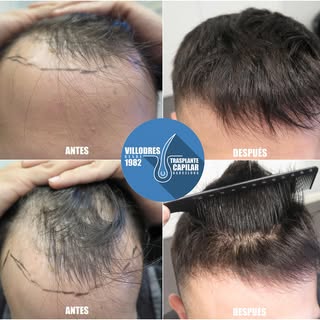 Resultado alopecia masculina 6 meses post op #fue #fuss #tira #mujer #pelo #trasplantecapilar #hairr