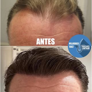 Alopecia masculina frontal. Resultado 6 meses después #fue #fuss #tira #mujer #pelo #trasplantecapil