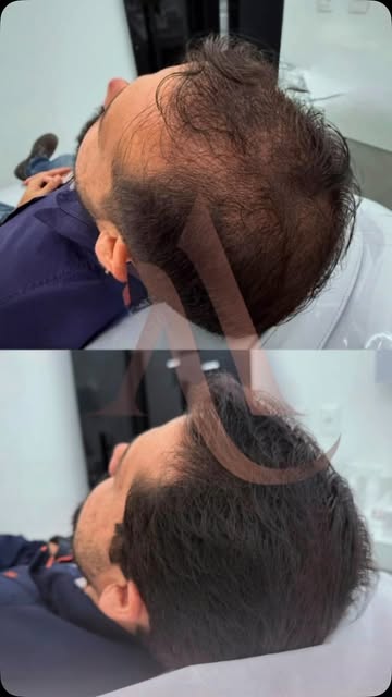 E se você pudesse recuperar seus fios sem precisar de um transplante capilar?

Esse antes e depois m